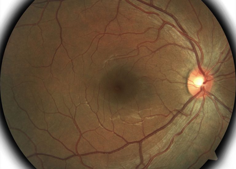 Red circle with a white circle and blood vessels coming form it - a retinal photo