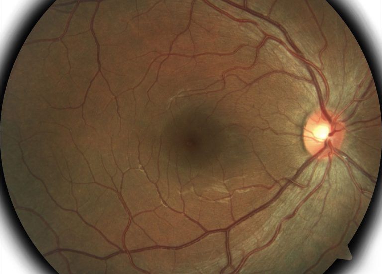 Red circle with a white circle and blood vessels coming form it - a retinal photo